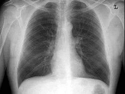 Tájékoztatás a tüdőszűrő vizsgálatról